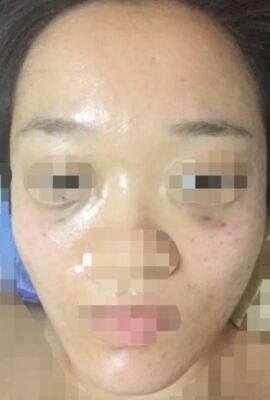 打了水光补水皮肤嫩滑有光泽了