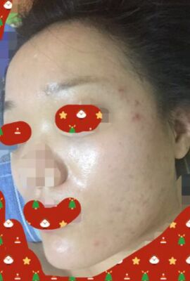 打了水光补水皮肤嫩滑有光泽了