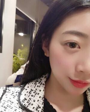 天津维美孙雪做的激光去雀斑后皮肤超干净