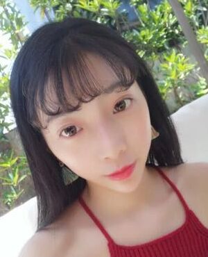 天津维美孙雪做的激光去雀斑后皮肤超干净