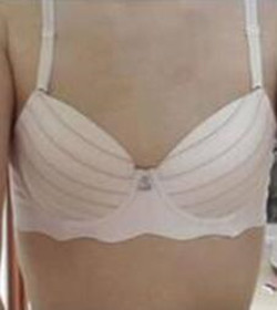 北京常好丽格三点定位双眼皮恢复一个月经历