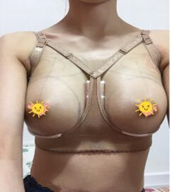 假体隆胸术让我告别小平胸 **