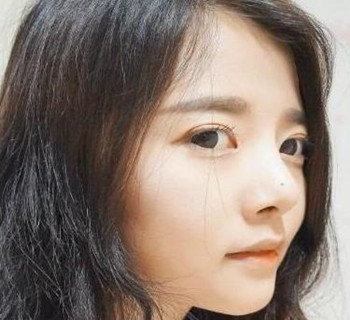 硅胶隆鼻手术圆了我高鼻梁的梦