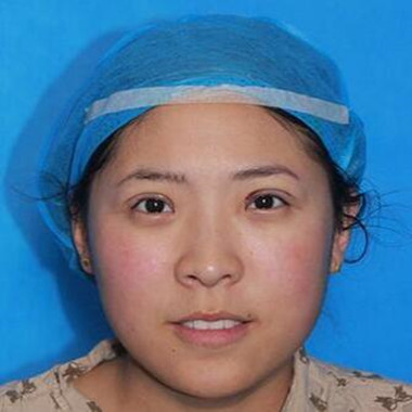 双眼皮手术让我单眼皮变双眼皮就是这么简单