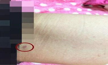 自体脂肪丰胸让我的小平胸变成大豪乳
