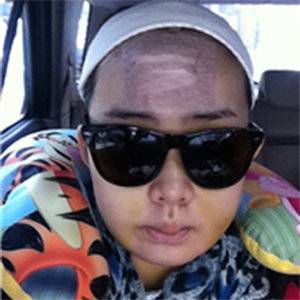 上海华美李志海做的v－line瓜子脸手术，果太好了~哈哈哈~