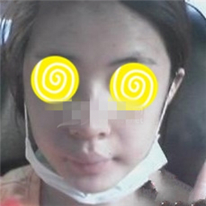 自体耳软骨隆鼻手术恢复过程和前后对比图分享，变化太大啦~~~