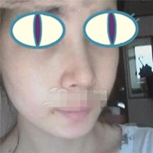 自体耳软骨隆鼻手术恢复过程和前后对比图分享，变化太大啦~~~