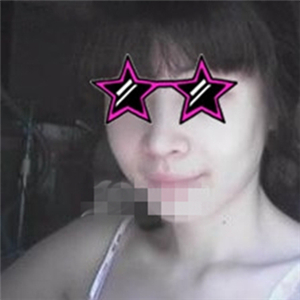 自体耳软骨隆鼻手术恢复过程和前后对比图分享，变化太大啦~~~