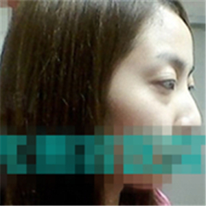 首尔丽格洪性范耳软骨隆鼻案例