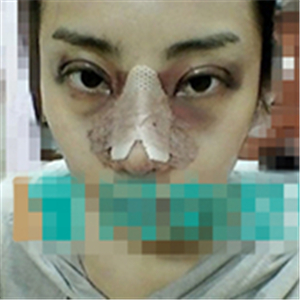 首尔丽格洪性范耳软骨隆鼻案例