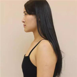 美女做双平面丰胸恢复过程和前后对比果图片分享，变化很大哦~~