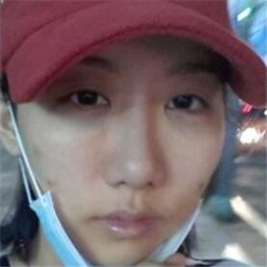 颧骨提高手术恢复前后的对比图片分享，果很好的说~