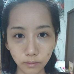 颧骨提高手术恢复前后的对比图片分享，果很好的说~