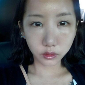 颧骨提高手术恢复前后的对比图片分享，果很好的说~