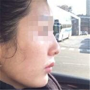 打B****告别大饼脸，恢复前后的对比果照片给你们看看哦