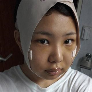 磨下颌角磨骨手术一个月了，分享一下恢复前后的果照片哇~