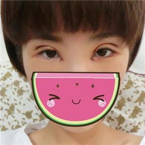 双眼皮手术失败修复一个月了，果不错，有前后对比果图片哦~