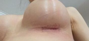 假体隆胸胸下切口还有痕迹图，不过已经比开始淡化了很多