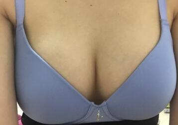 点击图片查看胸下切口假体隆胸恢复分享