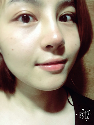 自体耳软骨隆鼻后颜值上升了有没有 莫琳娜葛红做的