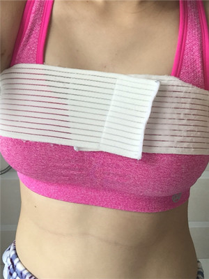 邱凌燕给我做了假体隆胸后 就挺了起来