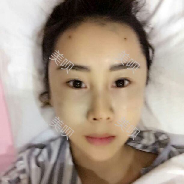 为大家分享一下韩国医生给我做的全脸自体脂肪面部填充