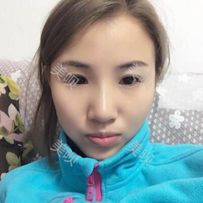 在惠州瑞芙臣做的隆鼻+玻尿酸隆下颌大家看看果怎么样