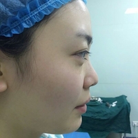 硅胶假体隆鼻后恢复得很漂亮下一步的目标是自体脂肪全脸填充