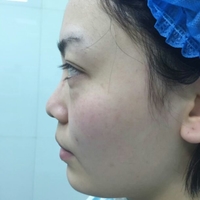 硅胶假体隆鼻后恢复得很漂亮下一步的目标是自体脂肪全脸填充