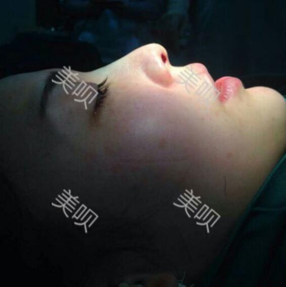 硅胶假体隆鼻后恢复得很漂亮下一步的目标是自体脂肪全脸填充