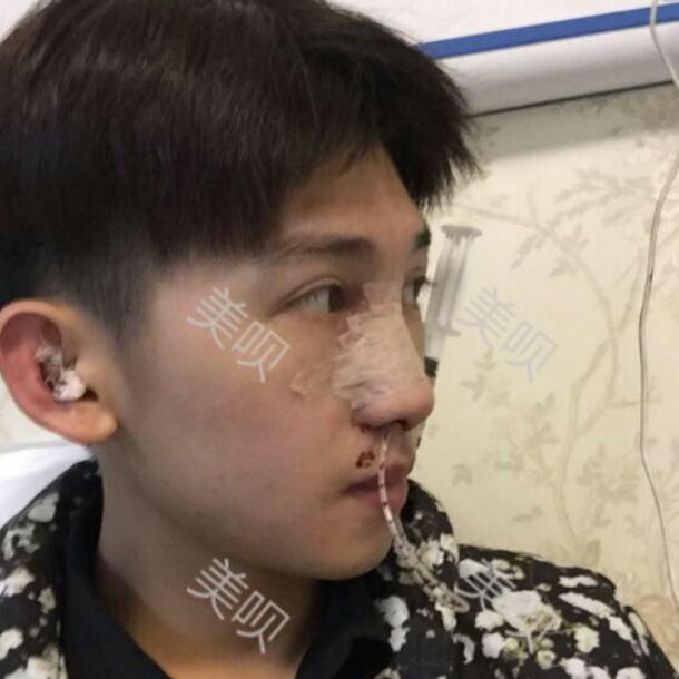 给大家分享一下我的膨体隆鼻恢复过程我要变得更帅哦