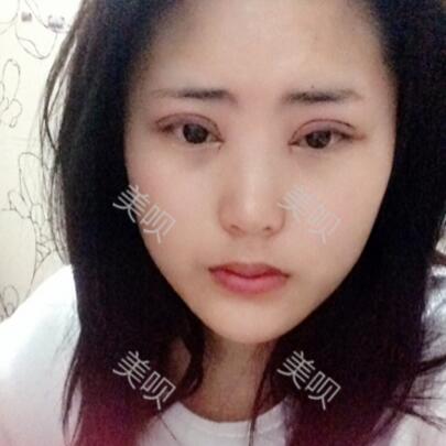 给大家看看我做的切开双眼皮+开眼角恢复全过程很漂亮哦