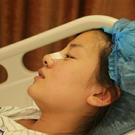 【真人案例】假体隆鼻手术前后过程分享