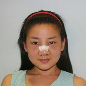 【真人案例】假体隆鼻手术前后过程分享