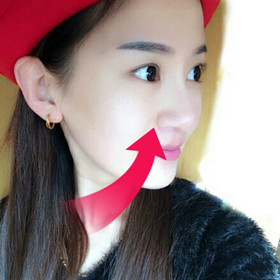 【真人案例】假体隆鼻手术前后过程分享