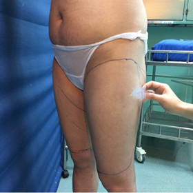 去年9月做的吸脂手术，大家来看看果怎么样