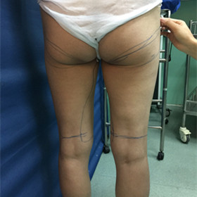 去年9月做的吸脂手术，大家来看看果怎么样