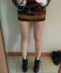 广州丽尚大腿抽脂三个月亲身经历