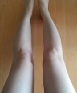 广州丽尚大腿抽脂三个月亲身经历