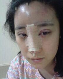 北京清木隆鼻+双眼皮恢复日记