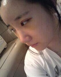 北京清木隆鼻+双眼皮恢复日记