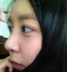 北京清木隆鼻整形后 **变身