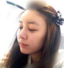 北京清木隆鼻整形后 **变身