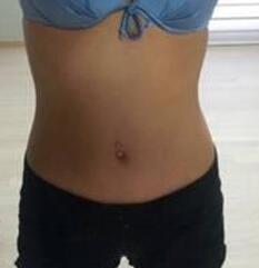 北京清木腰腹吸脂3个月感受