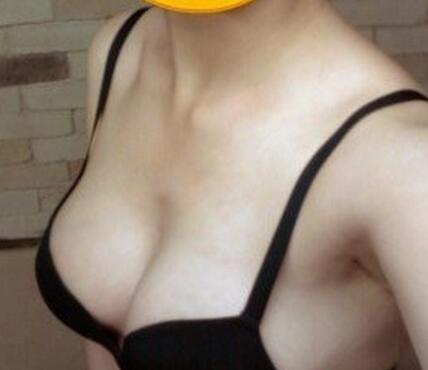 北京世熙自体脂肪隆胸2个月啦~