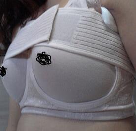 北京世熙自体脂肪隆胸,一下变到C罩杯