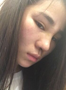 巨丑的鼻子做了隆鼻整形之后顺眼多了