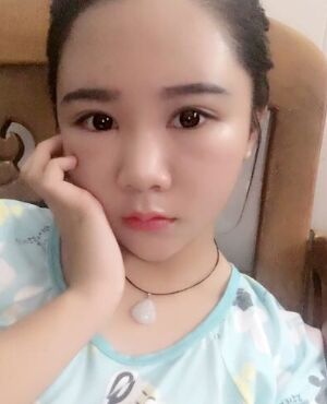 自体脂肪面部填充后脸型**了很多