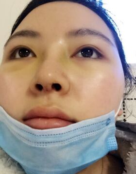 天津美莱吴胜做的硅胶假体隆鼻还垫鼻尖了